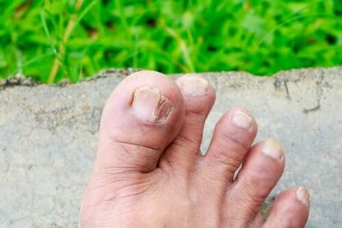 5 tipi di micosi della pelle e come riuscire a identificarle