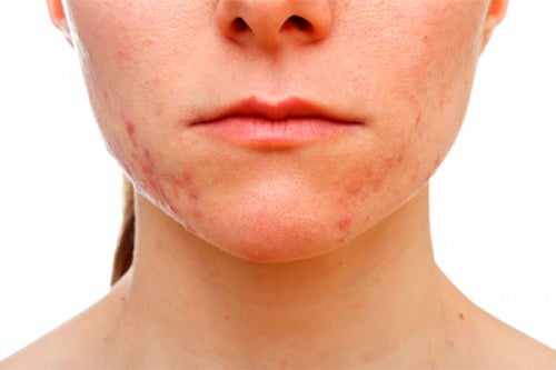 Alimenti che peggiorano l'acne