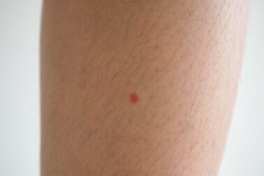 Macchie rosse sulle gambe: possibili cause e cosa fare