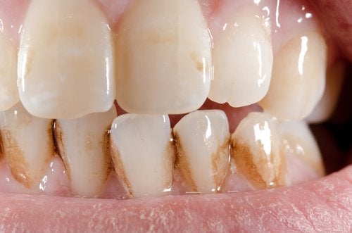 Tartaro sui denti: un aiuto per rimuoverlo in modo naturale