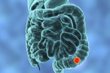 Tumore del colon-retto: i sintomi che meritano attenzione