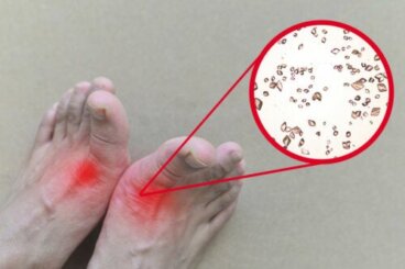 Come eliminare i cristalli di acido urico dalle articolazioni in modo naturale