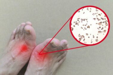 Come eliminare i cristalli di acido urico dalle articolazioni in modo naturale