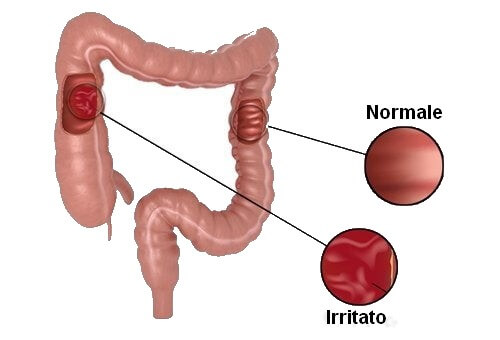 Sindrome dell'intestino irritabile: qual è la dieta ideale?
