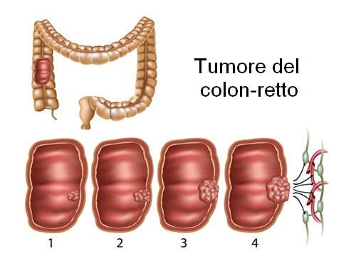 Stadi del tumore colon-retto