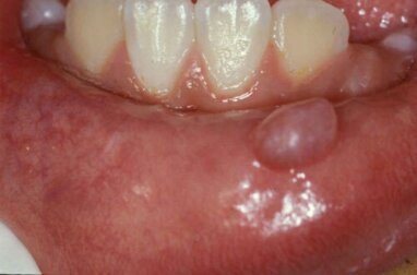 Mucocele: cos'è, quali sono le cause, i sintomi e il trattamento