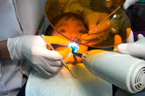 Che cos'è la sigillatura dei denti e a cosa serve?