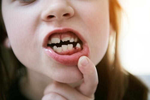 Molari dei 6 anni: i primi denti permanenti dei bambini