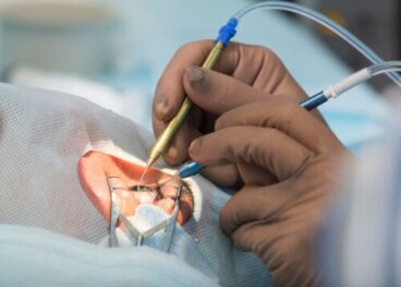 Effetti collaterali della chirurgia della cataratta