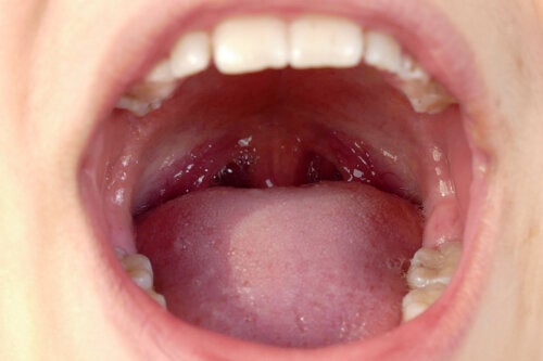 Come prevenire e rimuovere i calcoli tonsillari a casa