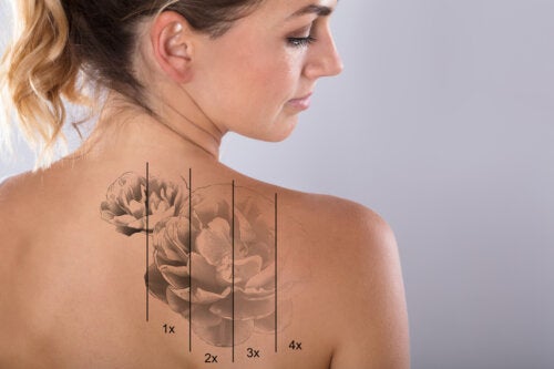 Quali sono i rischi della rimozione di un tatuaggio con il laser?