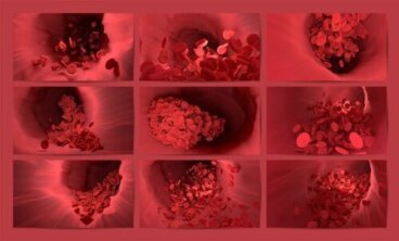 Fibrinolisi, il processo che impedisce la formazione di trombi