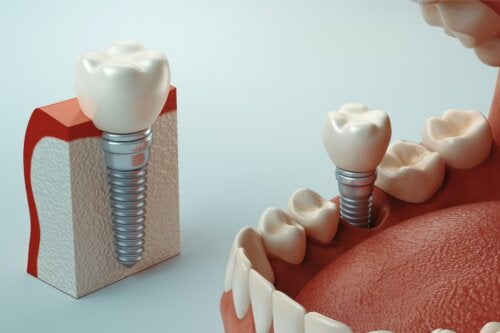 Che cos'è l'osteointegrazione degli impianti dentali?