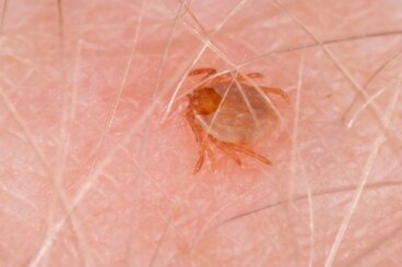 Febbre maculosa delle Montagne Rocciose: sintomi e trattamento