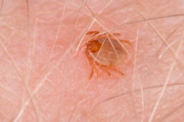 Febbre maculosa delle Montagne Rocciose: sintomi e trattamento