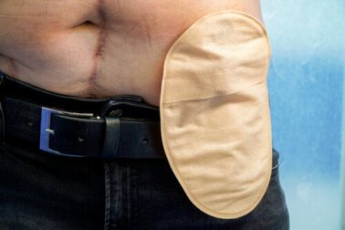 Suggerimenti da seguire dopo una stomia