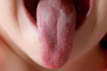 Perché si verifica l'infiammazione delle papille gustative?