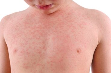 Roseola infantile: cos'è e come viene trattata