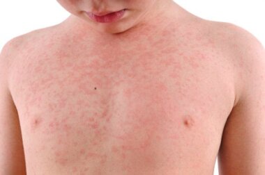 Roseola infantile: cos'è e come viene trattata