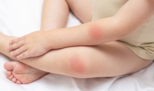 Macchie rosse sulla pelle: 25 possibili cause e trattamenti