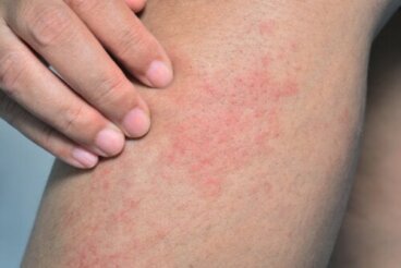 Screziatura della pelle o livedo reticularis: cause e trattamento