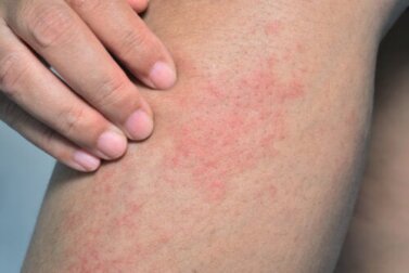 Screziatura della pelle o livedo reticularis: cause e trattamento