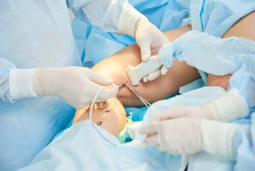 Scleroterapia delle vene varicose: come si esegue?