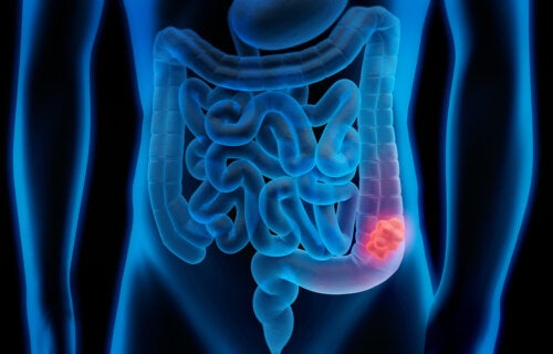 Scienziati spagnoli scoprono le cellule che causano la recidiva nel cancro del colon