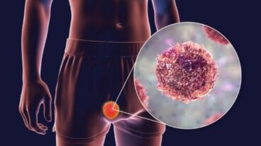 Teratoma: tipi, sintomi e trattamenti