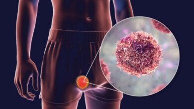 Teratoma: tipi, sintomi e trattamenti